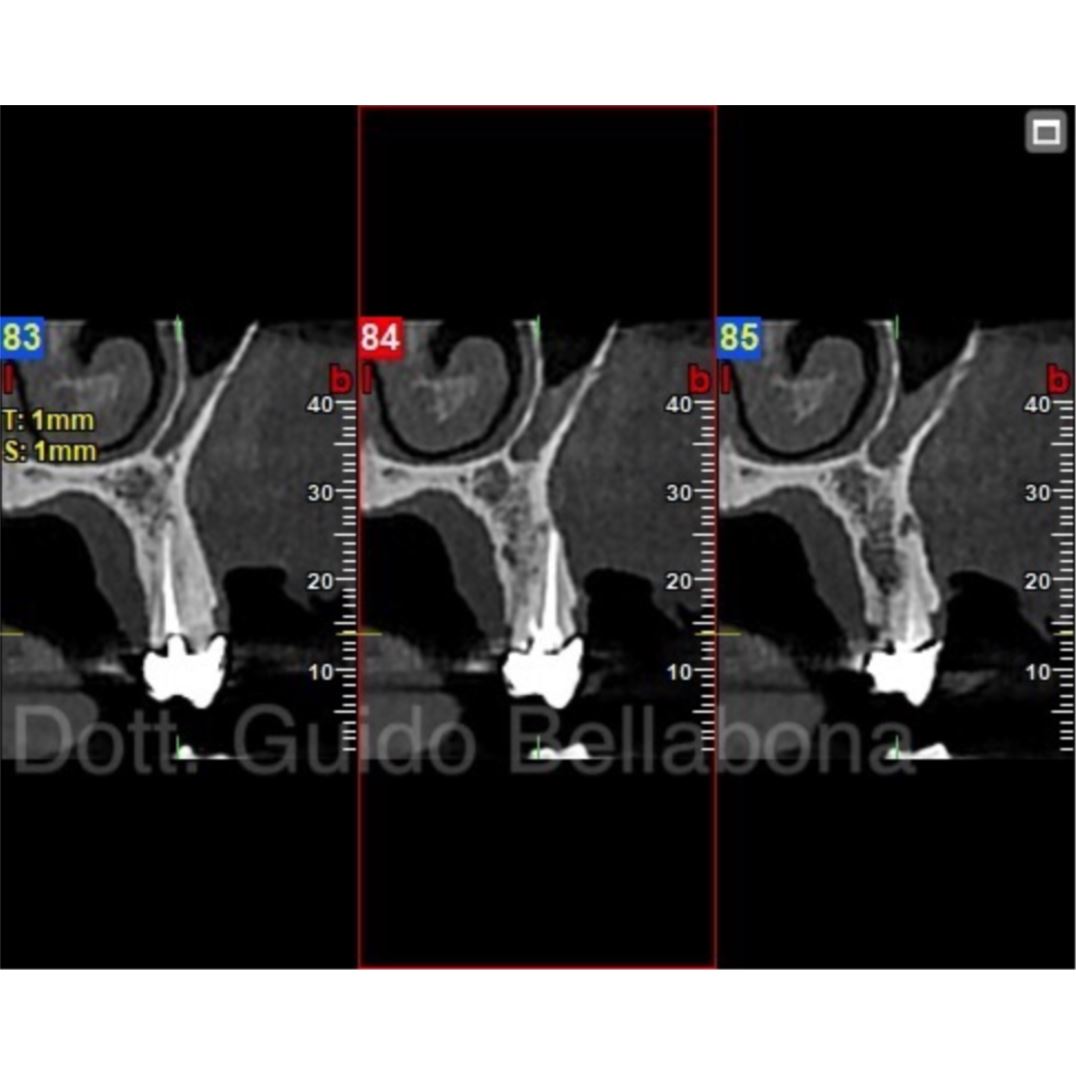 Intervento di chirurgia implantare protesicamente guidata 